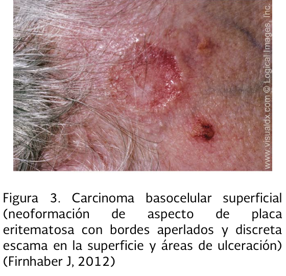 4. Cuadro clinico 2 - GPC-IMSS-360-19